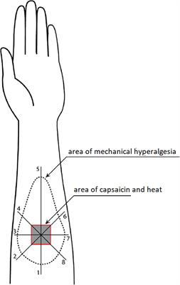 Does Electroacupuncture Have Different Effects on Peripheral and Central Sensitization in Humans: A Randomized Controlled Study